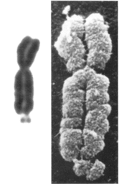 The fragile site is visible at the bottom end of the chromosome