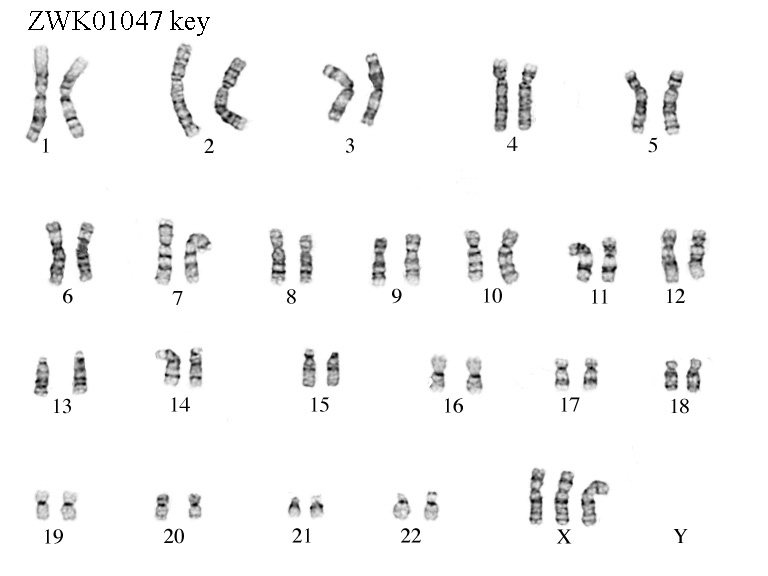 Triple X Syndrome The School Of Biomedical Sciences Wiki