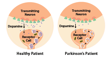 Parkinson's Disease - The School of Biomedical Sciences Wiki