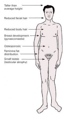 klinefelter syndrome in female